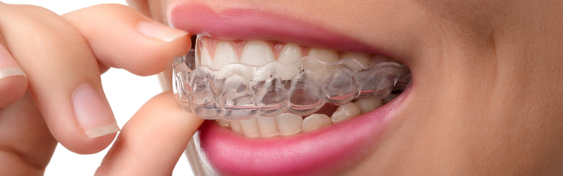 Invisalign in Manhattan: Achieve a Confident Smile at Smile Central Park